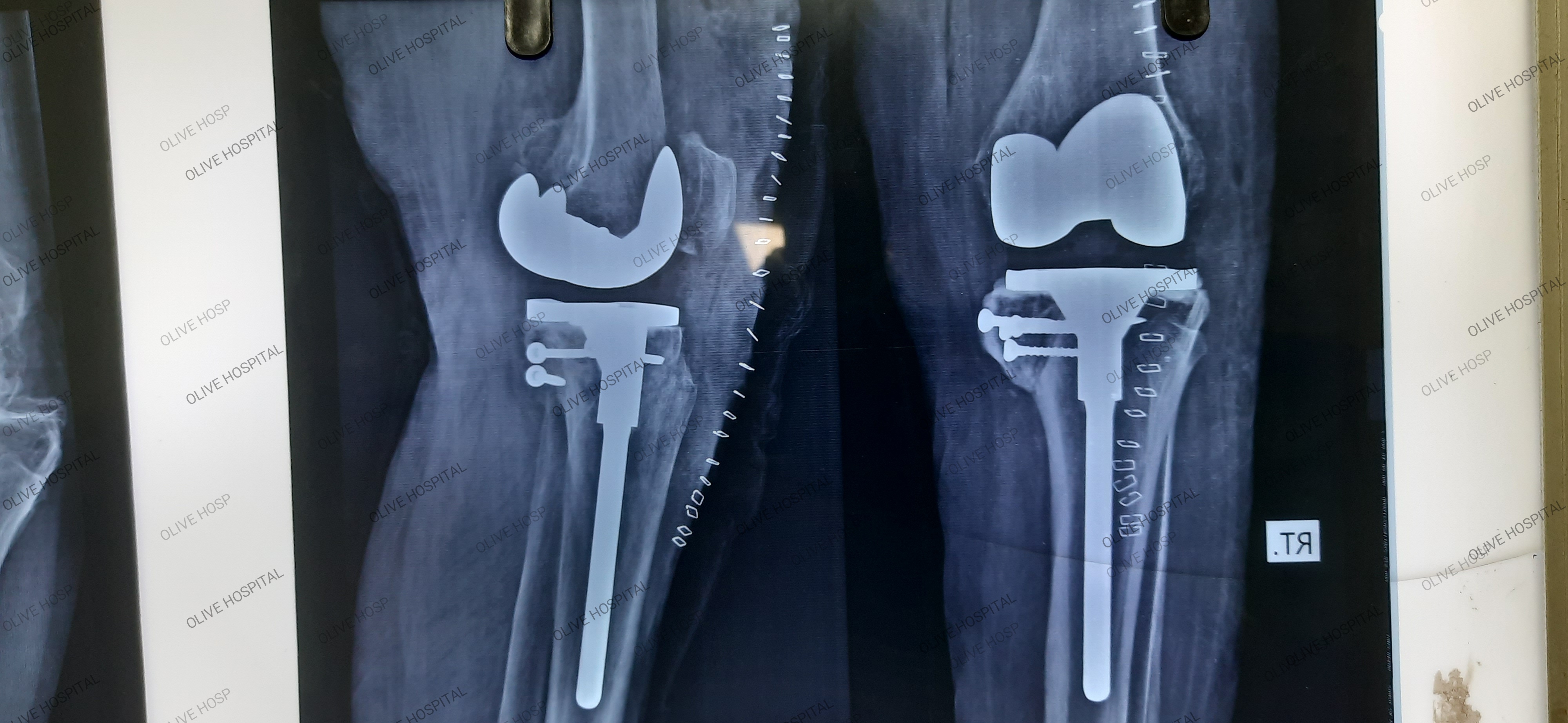 Best Knee Replacement TKR in Olive Hospital Patna