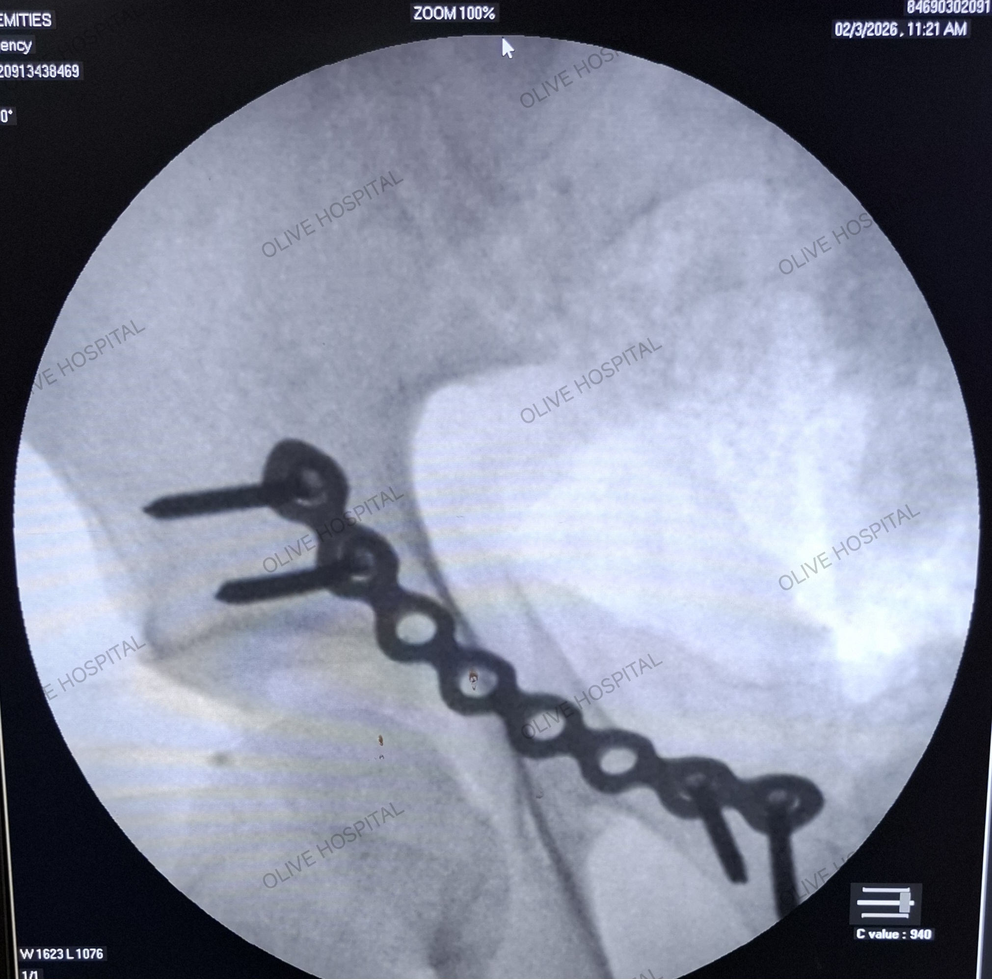 Anterior plating of Acetabulum